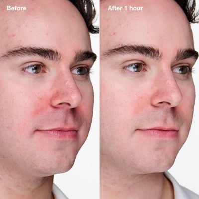 CLINIQUE Anti-Blemish Solutions ClinicalǢ Clearing Gel Priemonė nuo spuogų